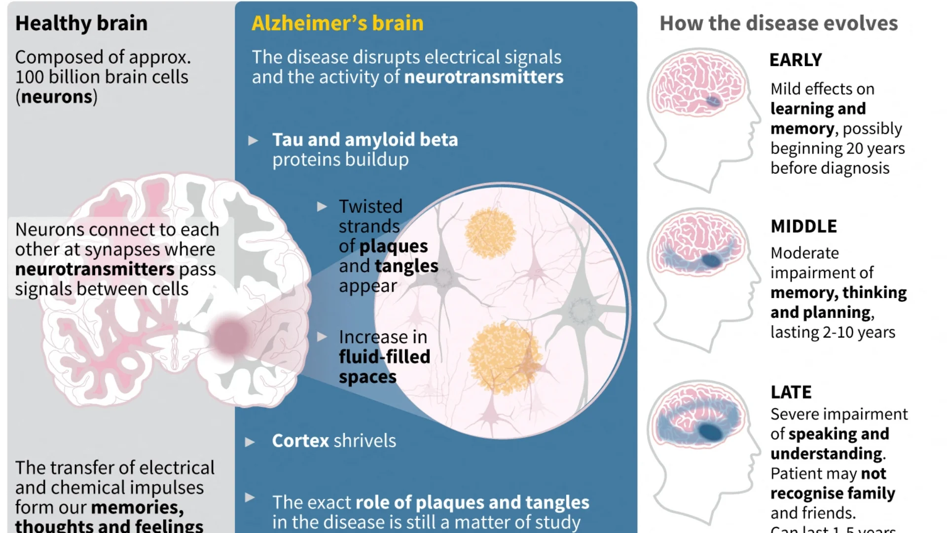 Alzheimer’s Risk Predicted Years Before Symptoms